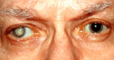 Cataract