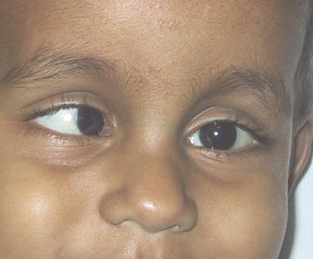 Eye Care