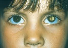 Eye condition