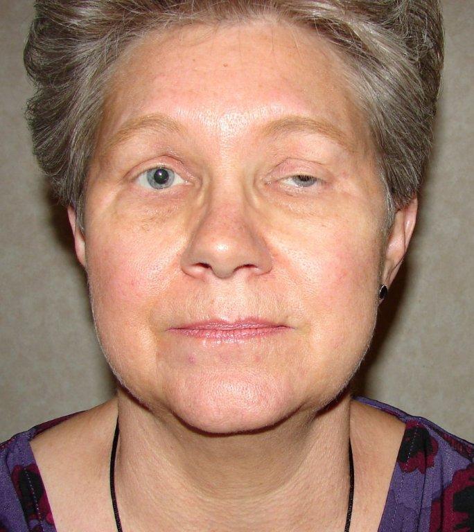 Patient with drooping upper eyelid before ptosis correction surgery
