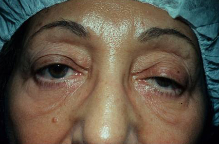 Post-operative result after ptosis correction surgery