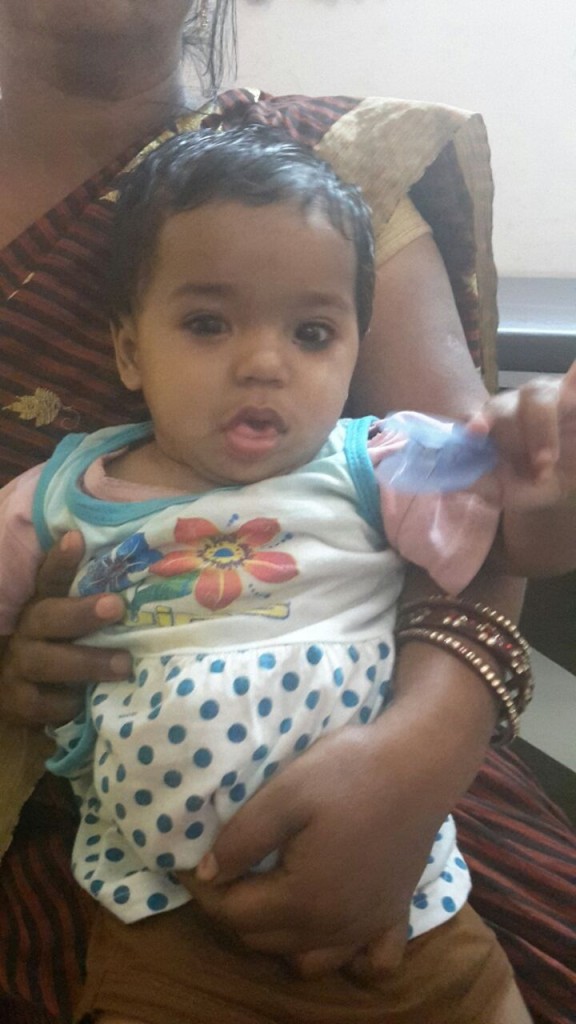Hypothyroid child before treatment