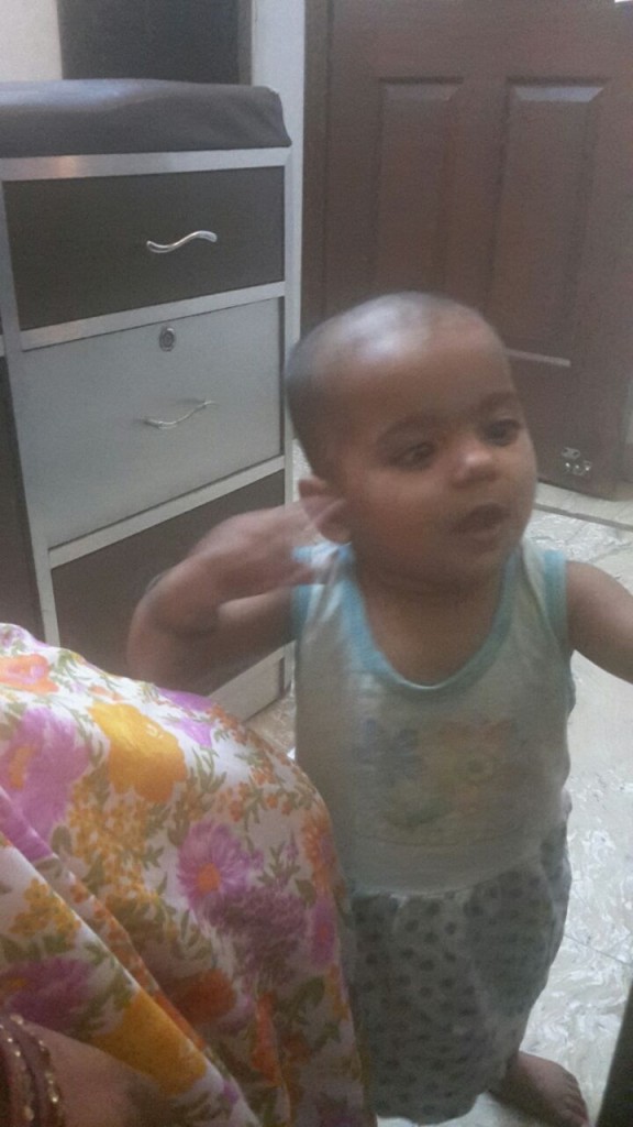 Hypothyroid child after treatment